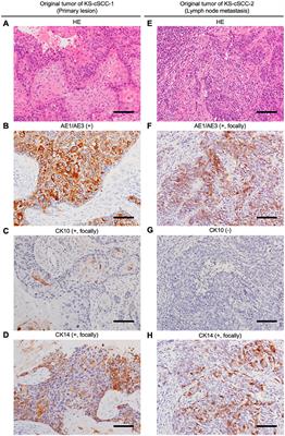 KS-cSCC-1 and KS-cSCC-2: two novel cutaneous squamous cell carcinoma cell lines established from Japanese patients